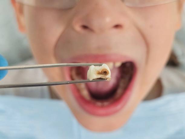 Best Emergency Wisdom Tooth Extraction in , CA
